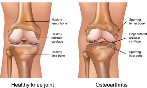 ginocchio con osteoartrosi